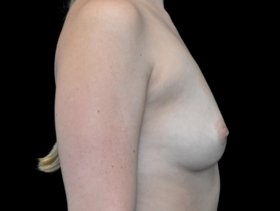 Breast Augmentation: Case 20 - Before