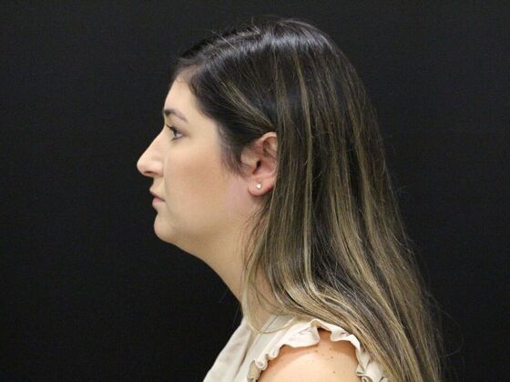 Liposuction: Case 36 - Before