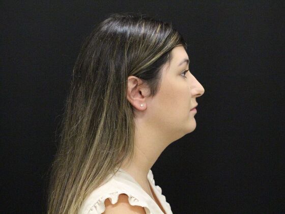 Liposuction Case 36 - Before