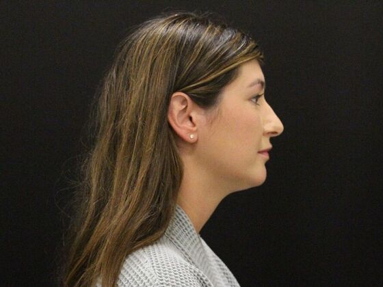 Liposuction Case 36 - After