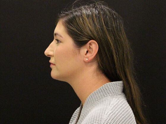 Liposuction: Case 36 - After