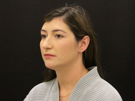 Liposuction: Case 36 - After