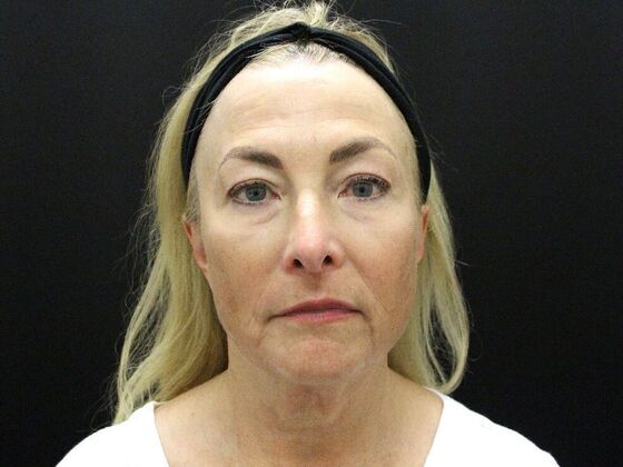 Face & Neck Lifts Case 49 - Before