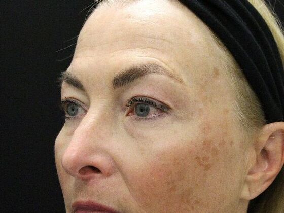 Eyelid Surgery: Case 15 - Before