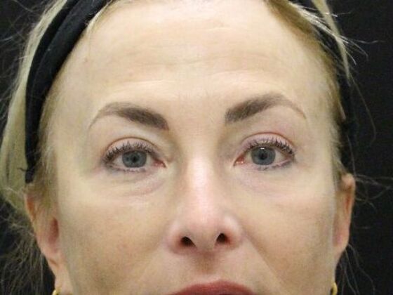 Eyelid Surgery: Case 15 - After