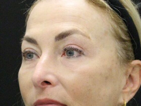 Eyelid Surgery: Case 15 - After