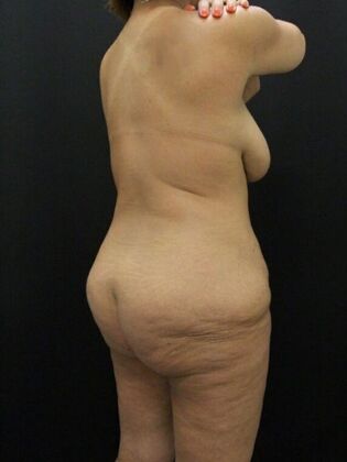 Liposuction: Case 37 - Before