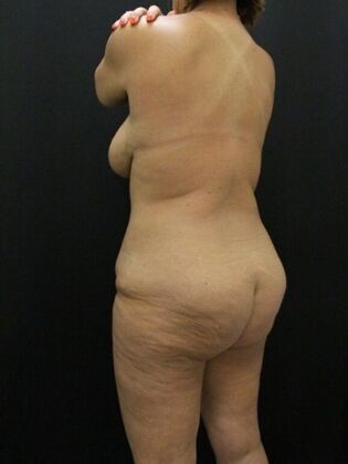 Liposuction: Case 37 - Before