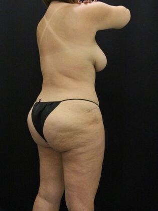 Liposuction: Case 37 - After