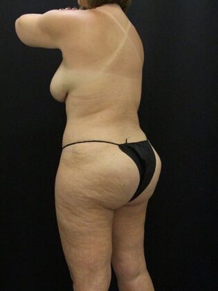 Liposuction: Case 37 - After