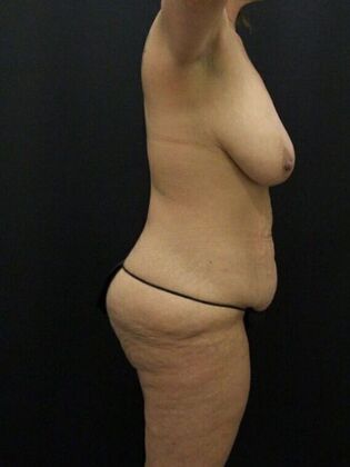 Tummy Tuck: Case 76 - Before