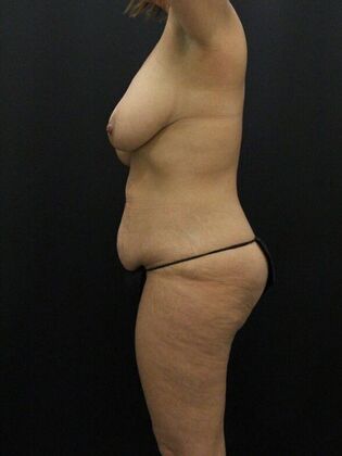 Tummy Tuck: Case 76 - Before