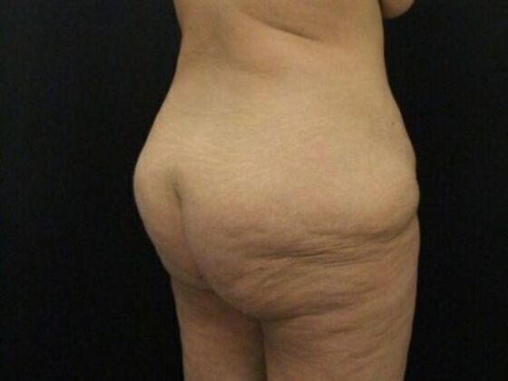 Brazilian Butt Lift Case 11 - Before