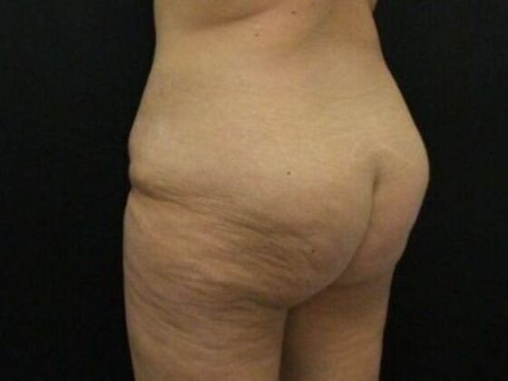 Brazilian Butt Lift: Case 11 - Before