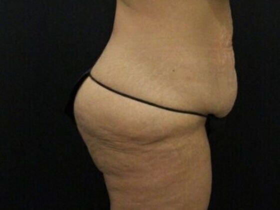 Brazilian Butt Lift: Case 11 - Before