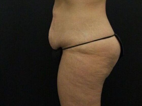 Brazilian Butt Lift: Case 11 - Before