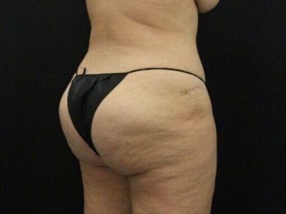 Brazilian Butt Lift Case 11 - After