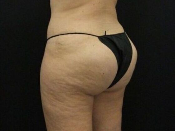 Brazilian Butt Lift: Case 11 - After