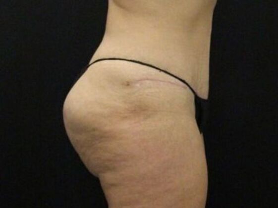 Brazilian Butt Lift: Case 11 - After