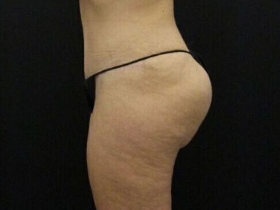 Brazilian Butt Lift: Case 11 - After