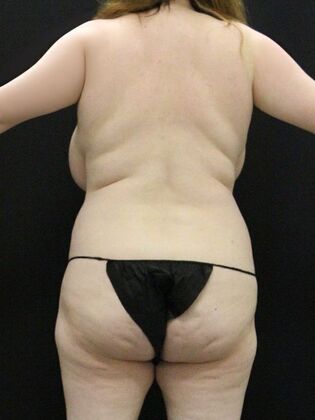 Liposuction Case 51 - Before