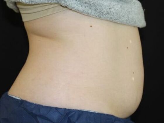 CoolSculpting Case 11 - Before