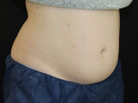 CoolSculpting: Case 11 - Before