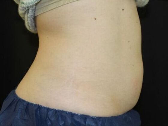 CoolSculpting Case 11 - After