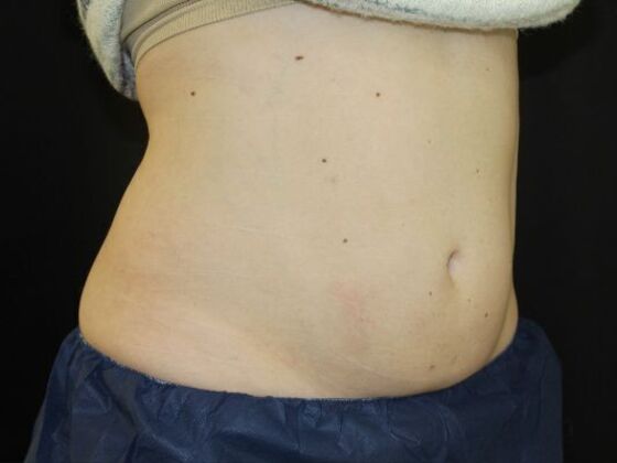 CoolSculpting: Case 11 - After
