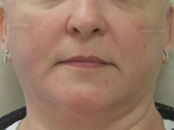 Injectables Case 79 - Before