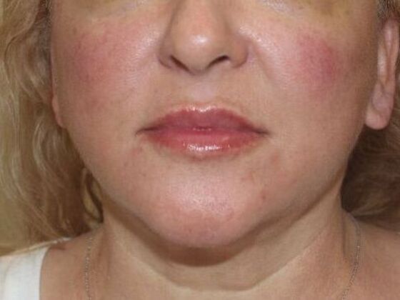 Injectables Case 79 - After