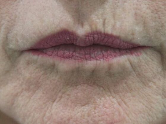 Injectables Case 80 - Before