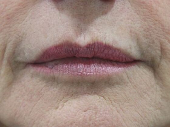 Injectables Case 80 - After