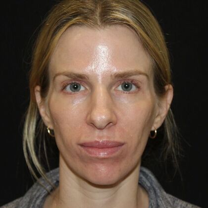 Skin Treatments: Case 13 - Before