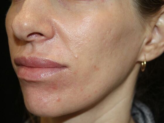 Skin Treatments Case 13 - Before