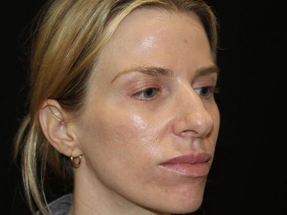 Skin Treatments: Case 13 - Before