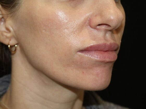 Skin Treatments: Case 13 - Before