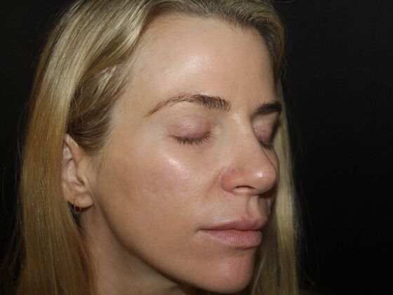 Skin Treatments: Case 13 - After