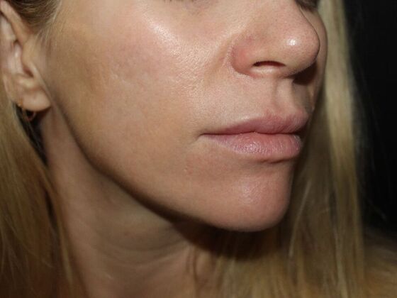 Skin Treatments: Case 13 - After