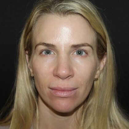 Skin Treatments: Case 13 - After