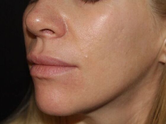 Skin Treatments Case 13 - After