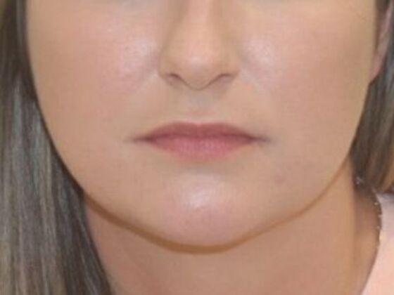 Injectables Case 81 - Before