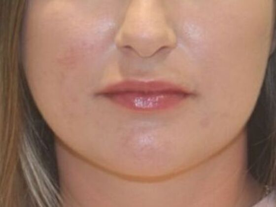 Injectables Case 81 - After