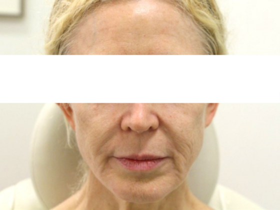 Injectables Case 82 - Before