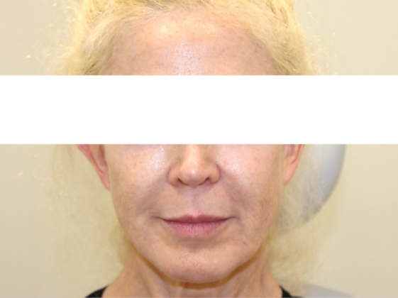 Injectables Case 82 - After
