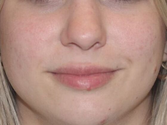 Injectables Case 83 - Before