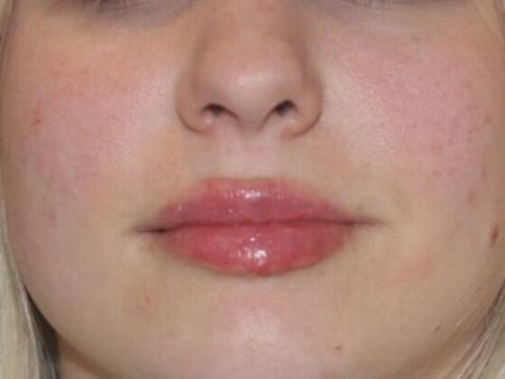 Injectables Case 83 - After