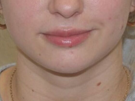Injectables Case 84 - Before