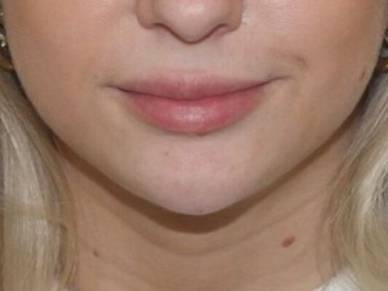 Injectables Case 84 - After