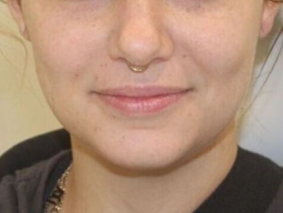 Injectables Case 85 - Before